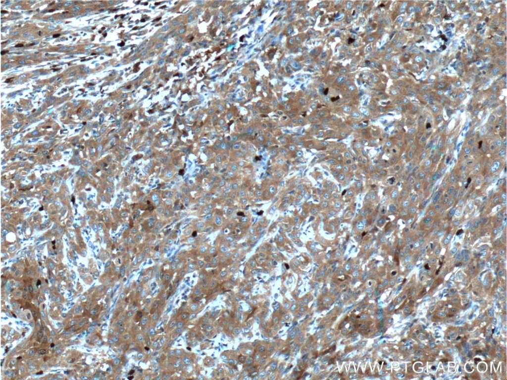 Immunohistochemistry (IHC) staining of human cervical cancer tissue using GART Polyclonal antibody (13659-1-AP)