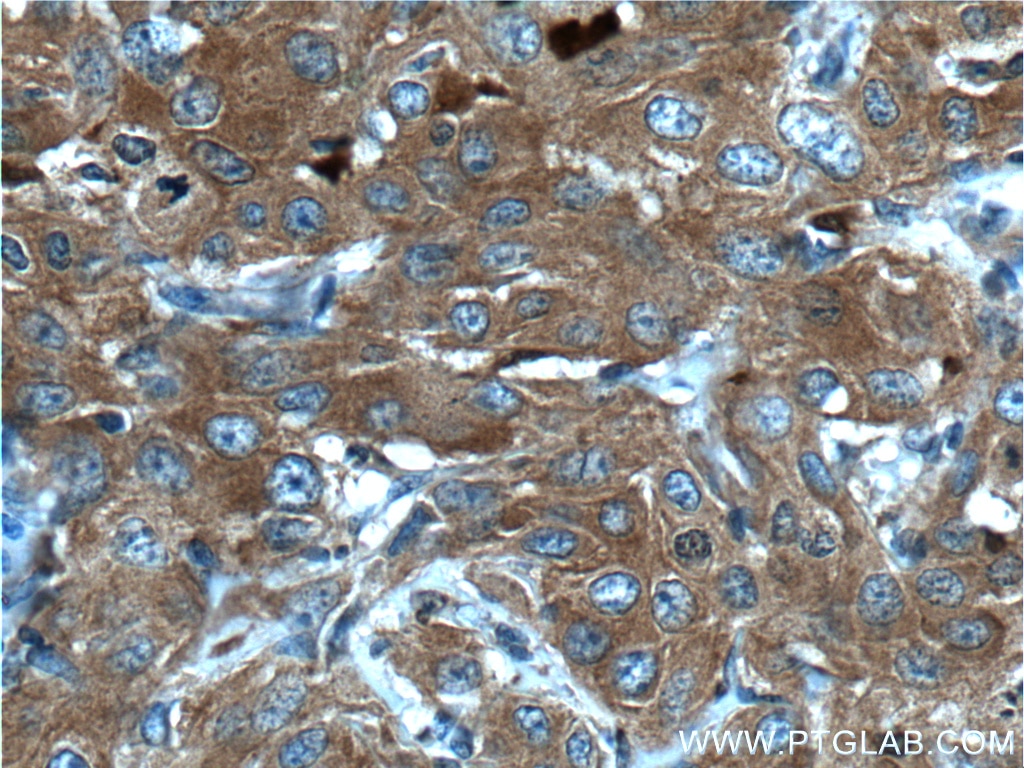 Immunohistochemistry (IHC) staining of human cervical cancer tissue using GART Polyclonal antibody (13659-1-AP)