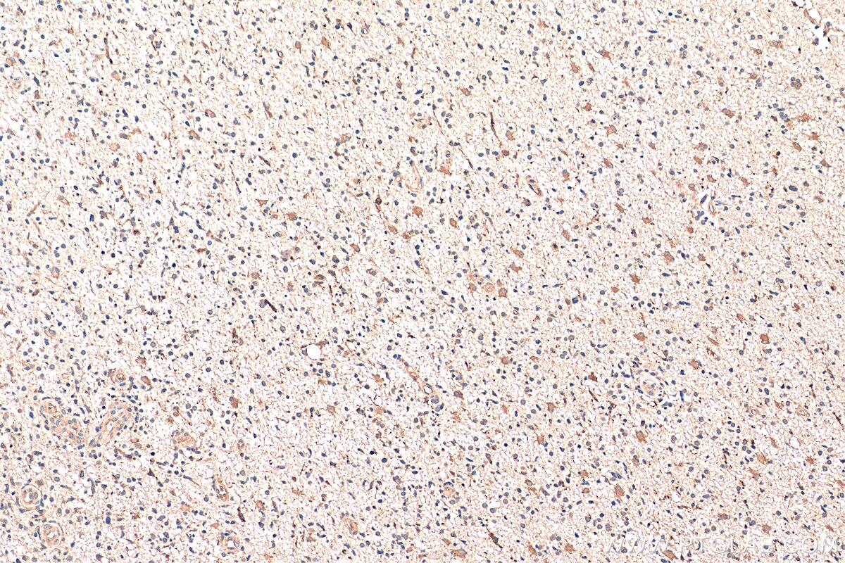 Immunohistochemistry (IHC) staining of human gliomas tissue using GAS1 Polyclonal antibody (17903-1-AP)