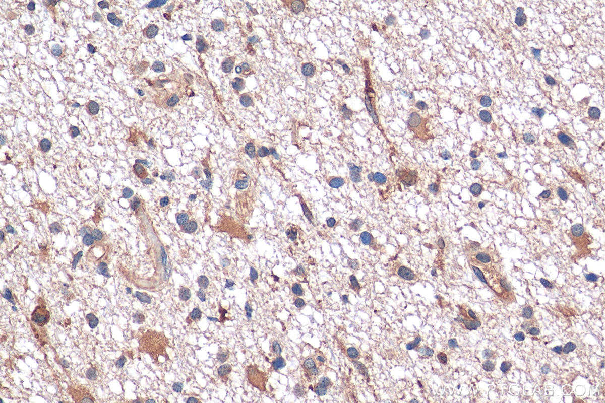 IHC staining of human gliomas using 17903-1-AP
