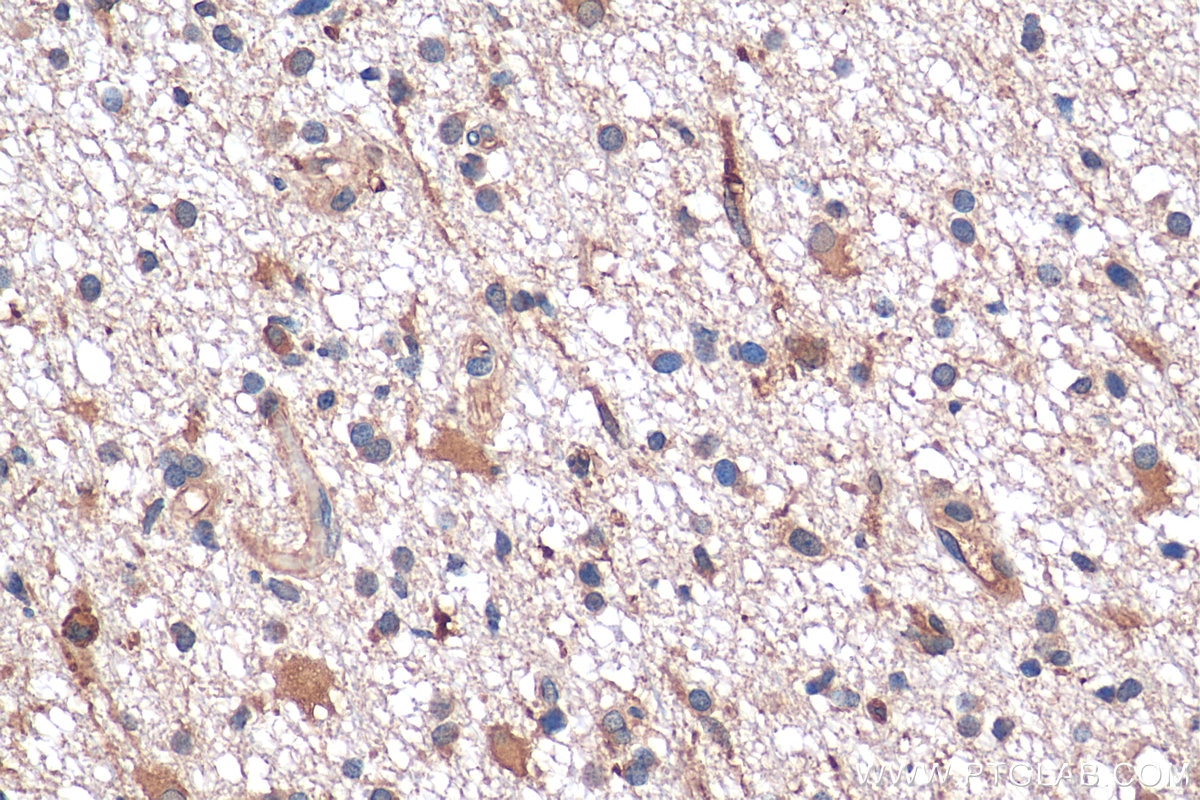 Immunohistochemistry (IHC) staining of human gliomas tissue using GAS1 Polyclonal antibody (17903-1-AP)