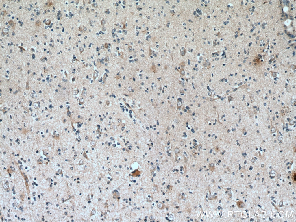 IHC staining of human gliomas using 67181-1-Ig