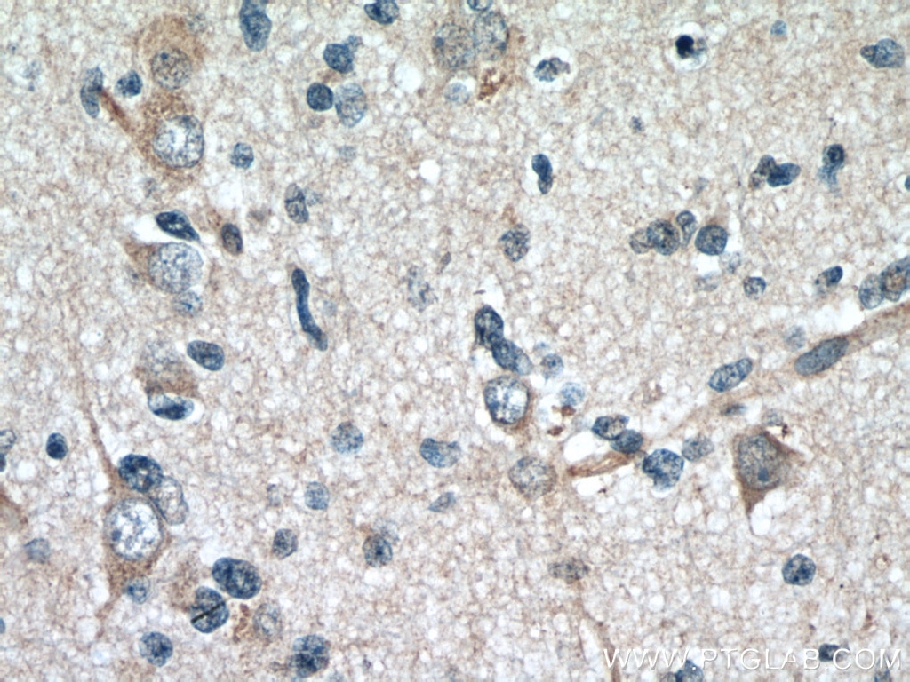 Immunohistochemistry (IHC) staining of human gliomas tissue using GAS1 Monoclonal antibody (67181-1-Ig)