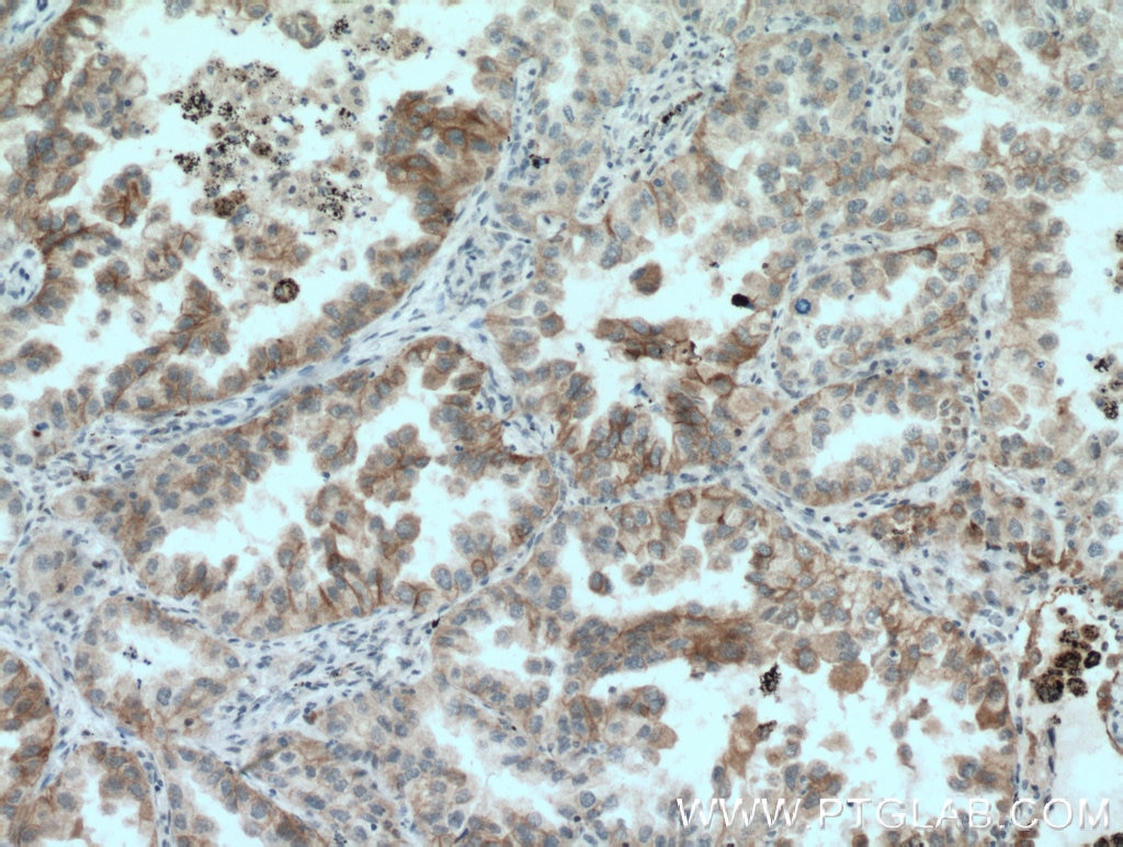 Immunohistochemistry (IHC) staining of human lung cancer tissue using GAS2 Polyclonal antibody (11941-2-AP)