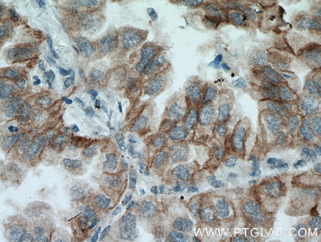 Immunohistochemistry (IHC) staining of human lung cancer tissue using GAS2 Polyclonal antibody (11941-2-AP)