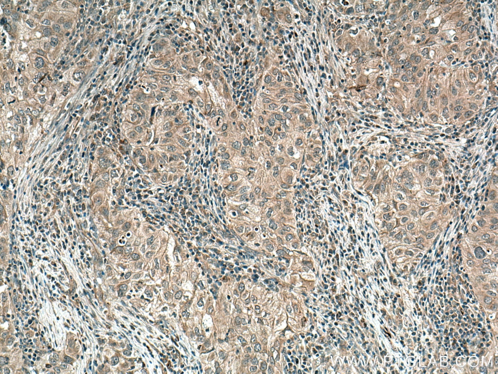 IHC staining of human lung cancer using 13795-1-AP
