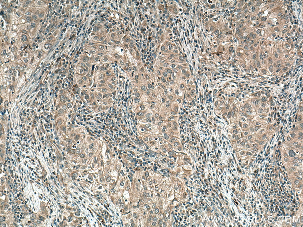 Immunohistochemistry (IHC) staining of human lung cancer tissue using GAS6 Polyclonal antibody (13795-1-AP)