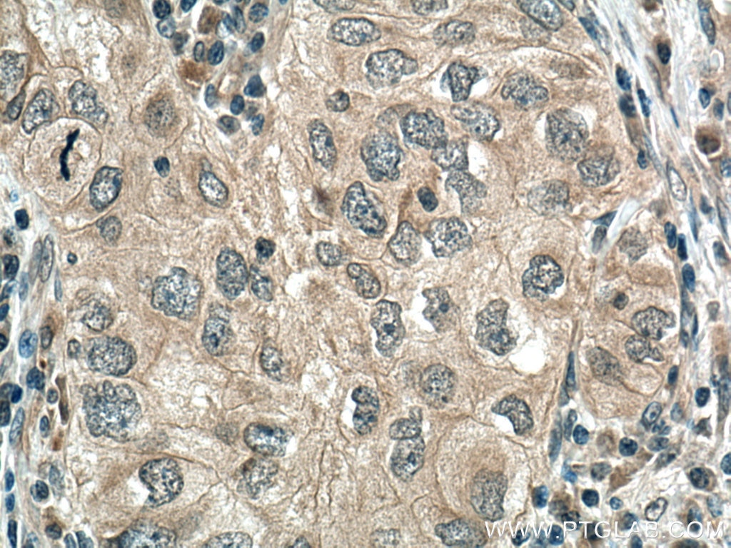 Immunohistochemistry (IHC) staining of human lung cancer tissue using GAS6 Polyclonal antibody (13795-1-AP)