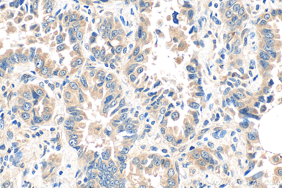Immunohistochemistry (IHC) staining of human lung cancer tissue using GAS6 Polyclonal antibody (13795-1-AP)