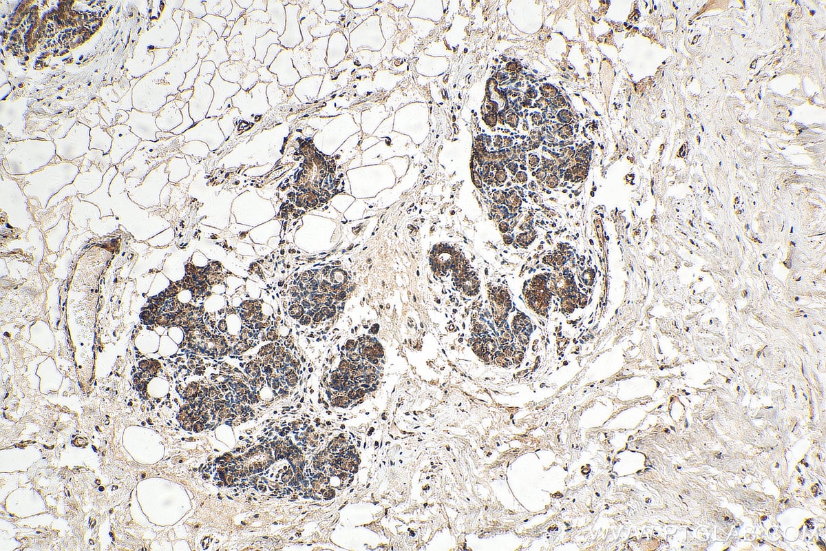 Immunohistochemistry (IHC) staining of human breast hyperplasia tissue using GATA1 Monoclonal antibody (60011-1-Ig)