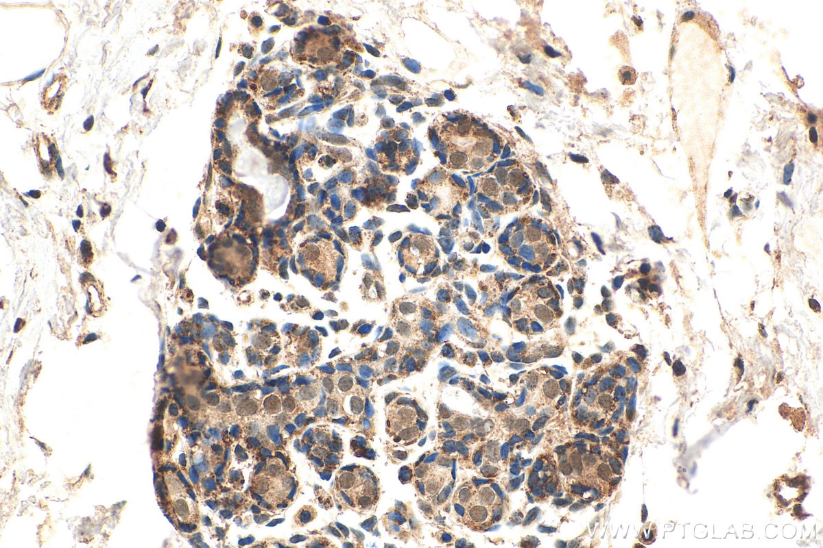 Immunohistochemistry (IHC) staining of human breast hyperplasia tissue using GATA1 Monoclonal antibody (60011-1-Ig)