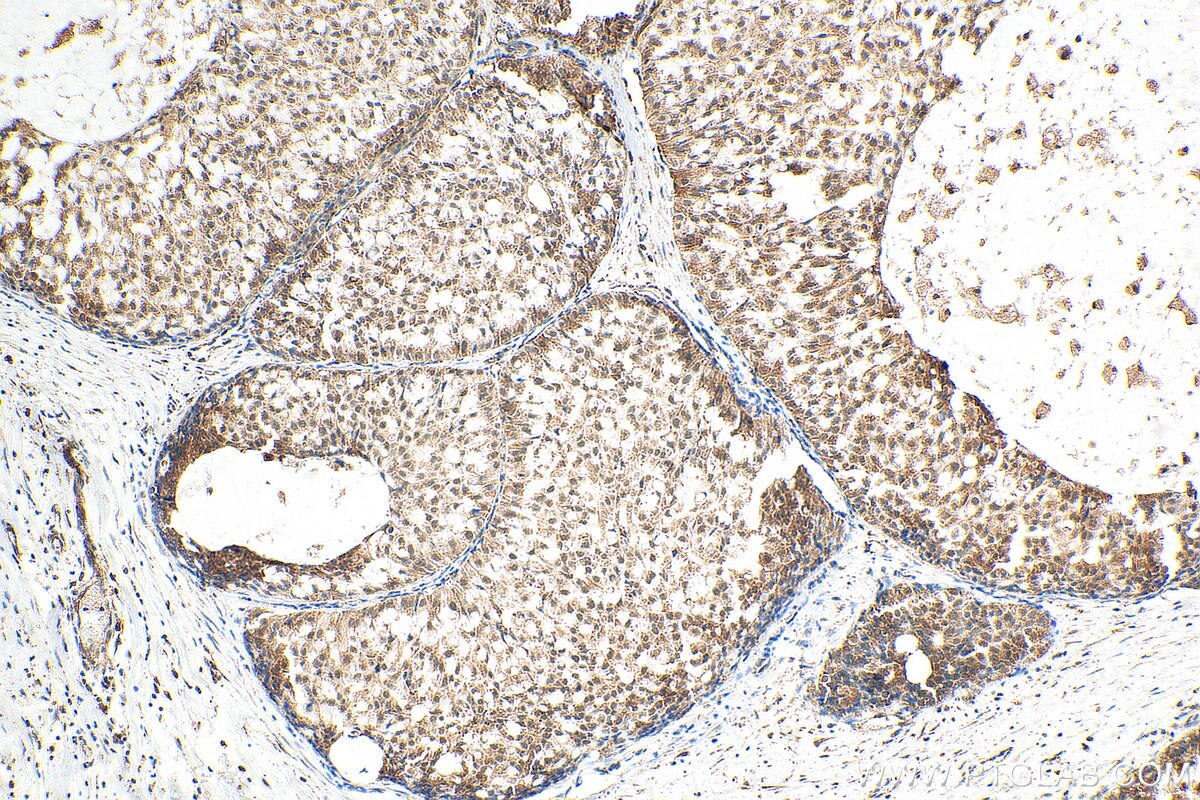 IHC staining of human breast hyperplasia using 60011-1-Ig