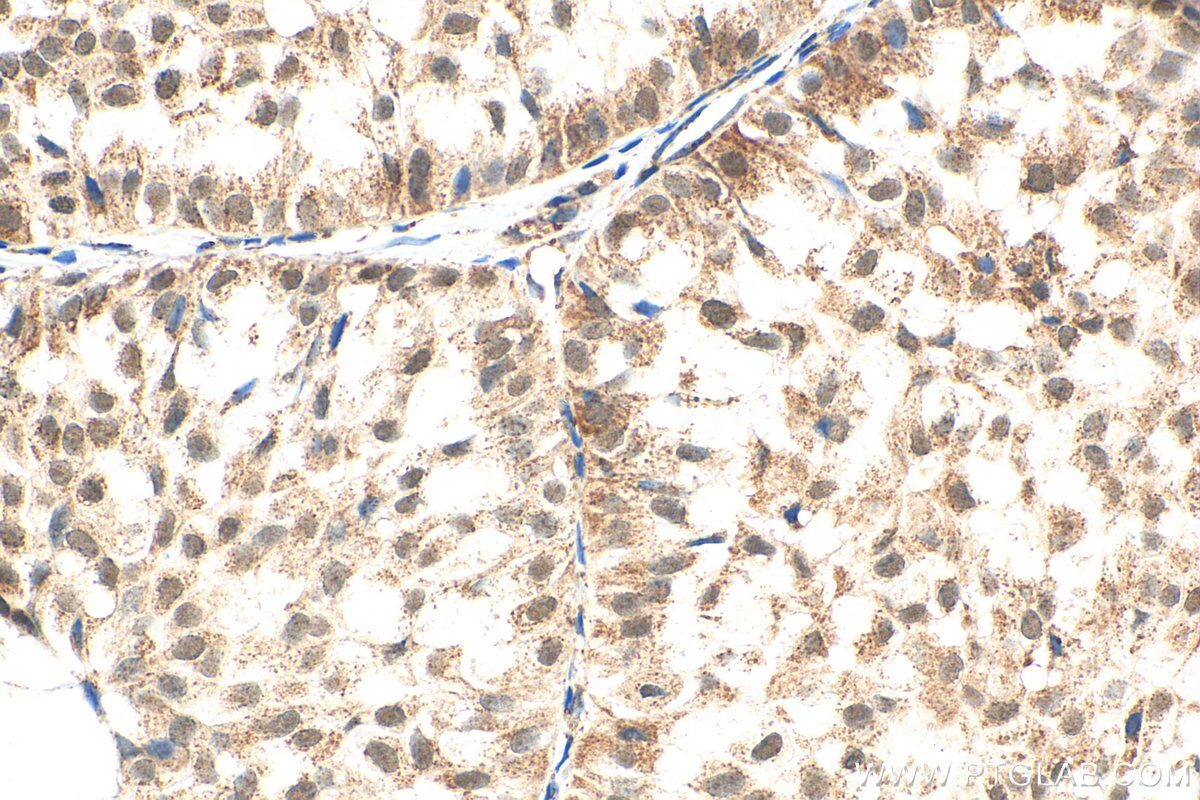 IHC staining of human breast hyperplasia using 60011-1-Ig