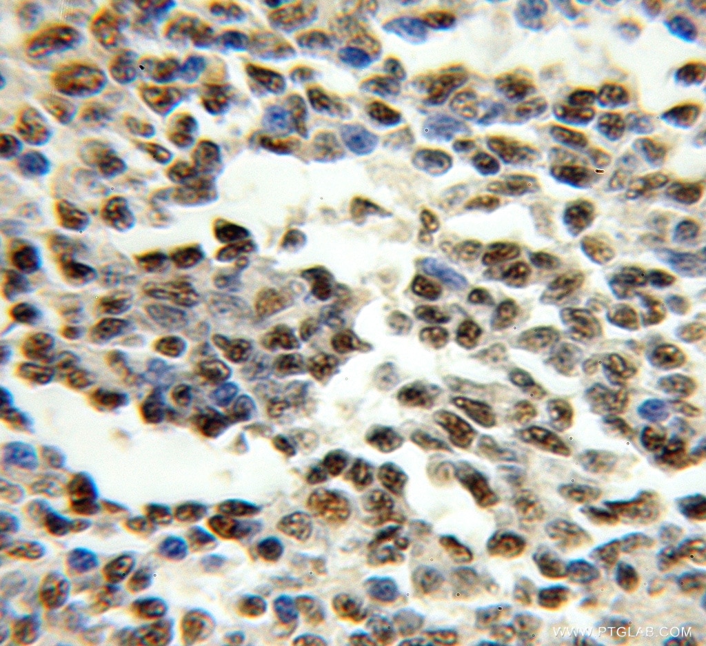 Immunohistochemistry (IHC) staining of human lymphoma tissue using GATA2 Polyclonal antibody (11103-1-AP)