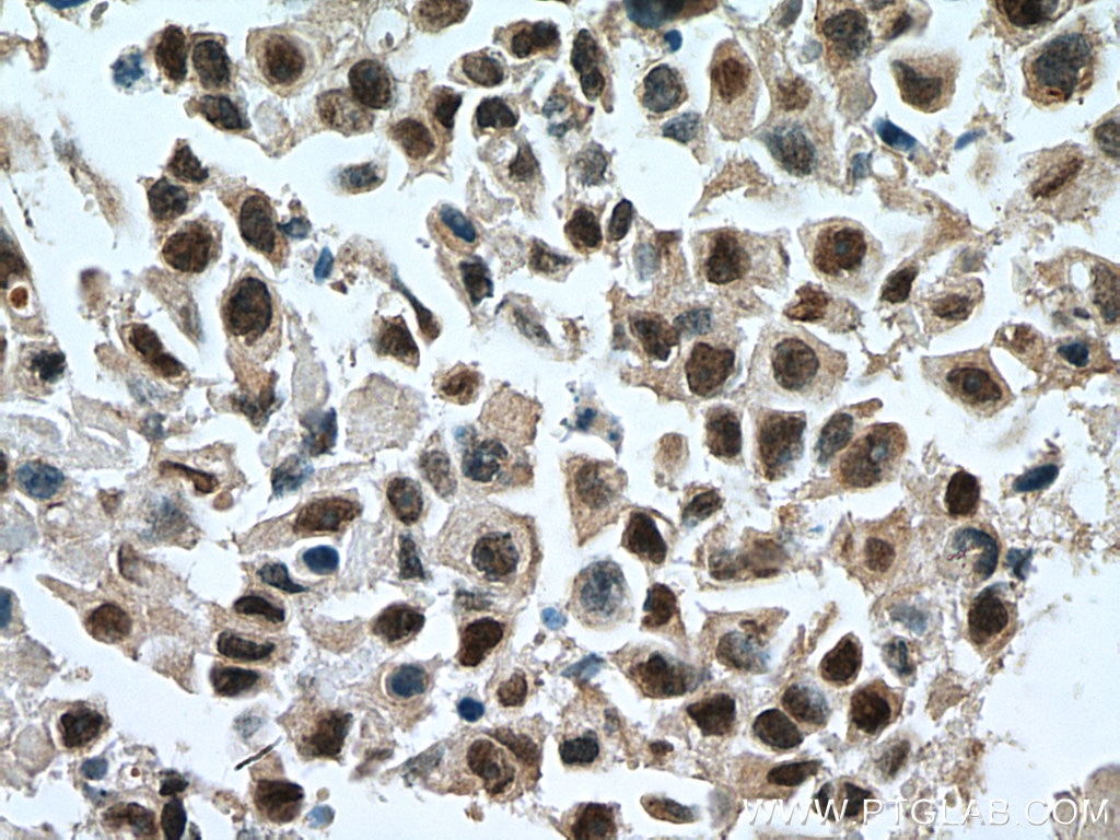 Immunohistochemistry (IHC) staining of human breast cancer tissue using GATA3 Polyclonal antibody (10417-1-AP)