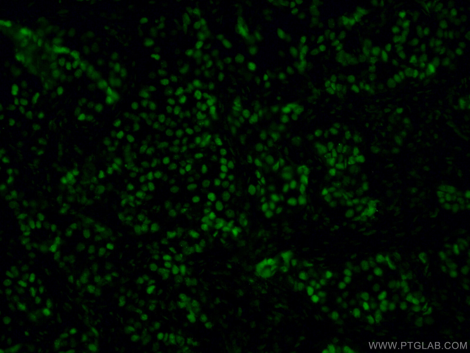 Immunofluorescence (IF) / fluorescent staining of human breast cancer tissue using GATA3 Monoclonal antibody (66400-1-Ig)