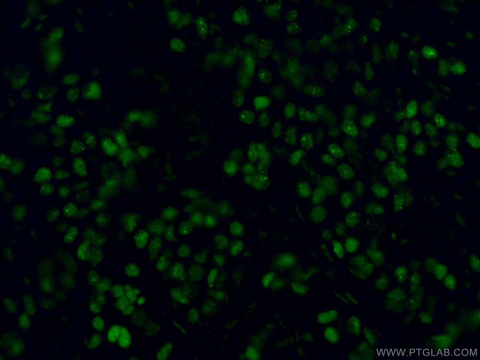 Immunofluorescence (IF) / fluorescent staining of human breast cancer tissue using GATA3 Monoclonal antibody (66400-1-Ig)