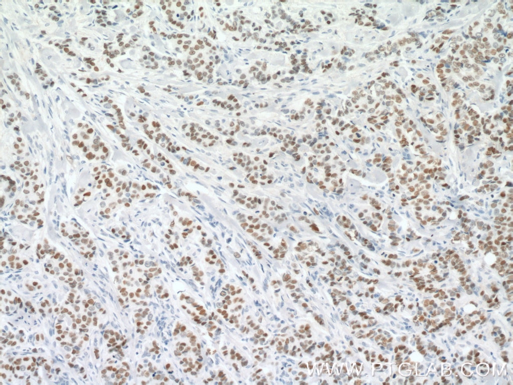 Immunohistochemistry (IHC) staining of human breast cancer tissue using GATA3 Monoclonal antibody (66400-1-Ig)
