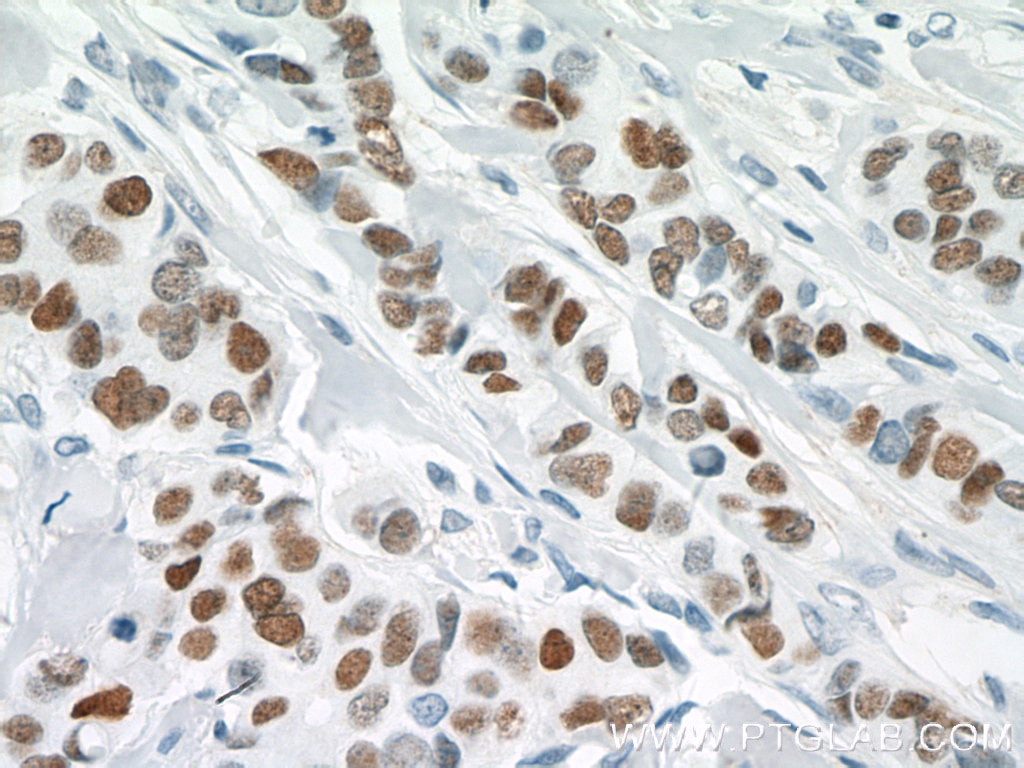 Immunohistochemistry (IHC) staining of human breast cancer tissue using GATA3 Monoclonal antibody (66400-1-Ig)