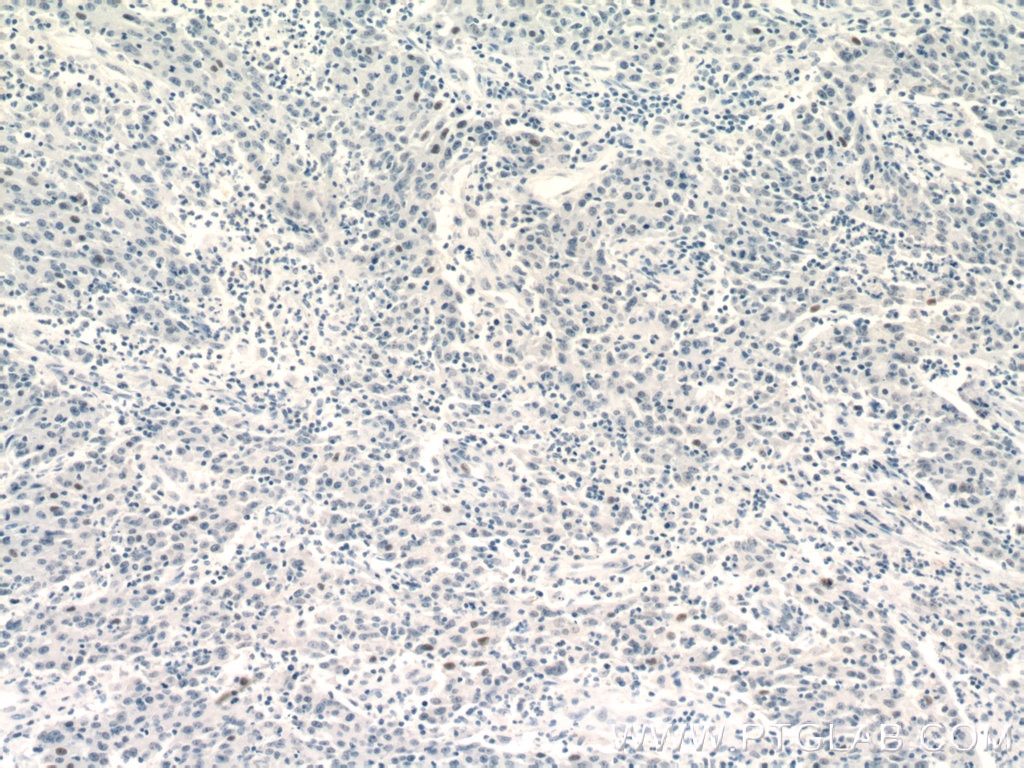 Immunohistochemistry (IHC) staining of human colon cancer tissue using GATA3 Monoclonal antibody (66400-1-Ig)