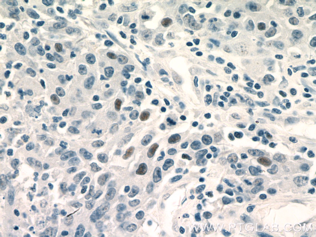Immunohistochemistry (IHC) staining of human colon cancer tissue using GATA3 Monoclonal antibody (66400-1-Ig)