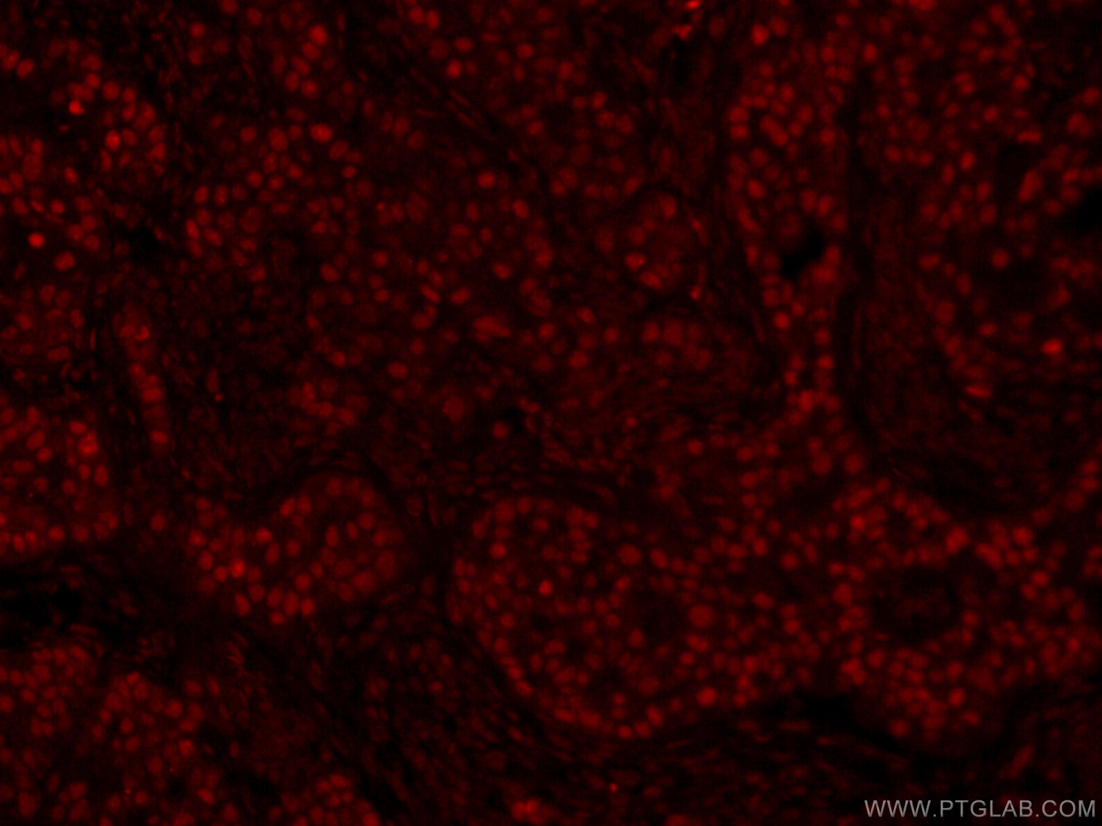 Immunofluorescence (IF) / fluorescent staining of human breast cancer tissue using CoraLite®594-conjugated GATA3 Monoclonal antibody (CL594-66400)