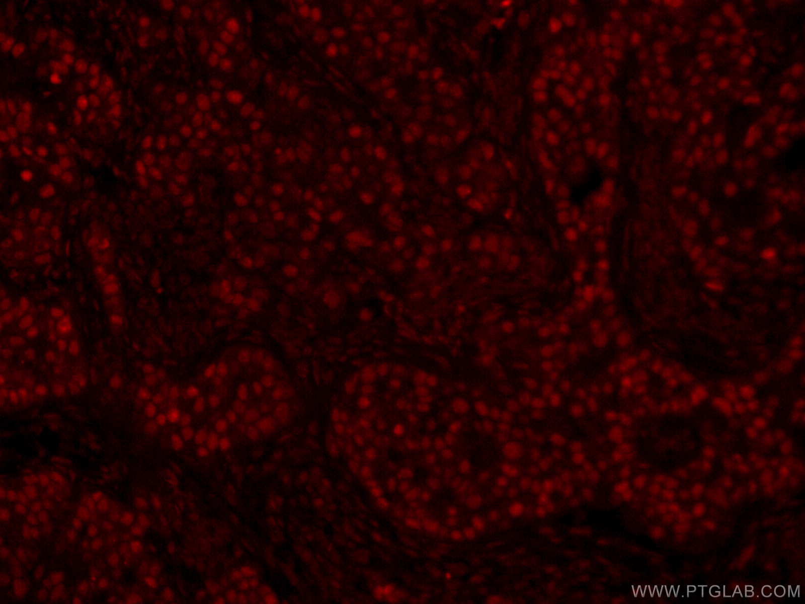 IF Staining of human breast cancer using CL594-66400