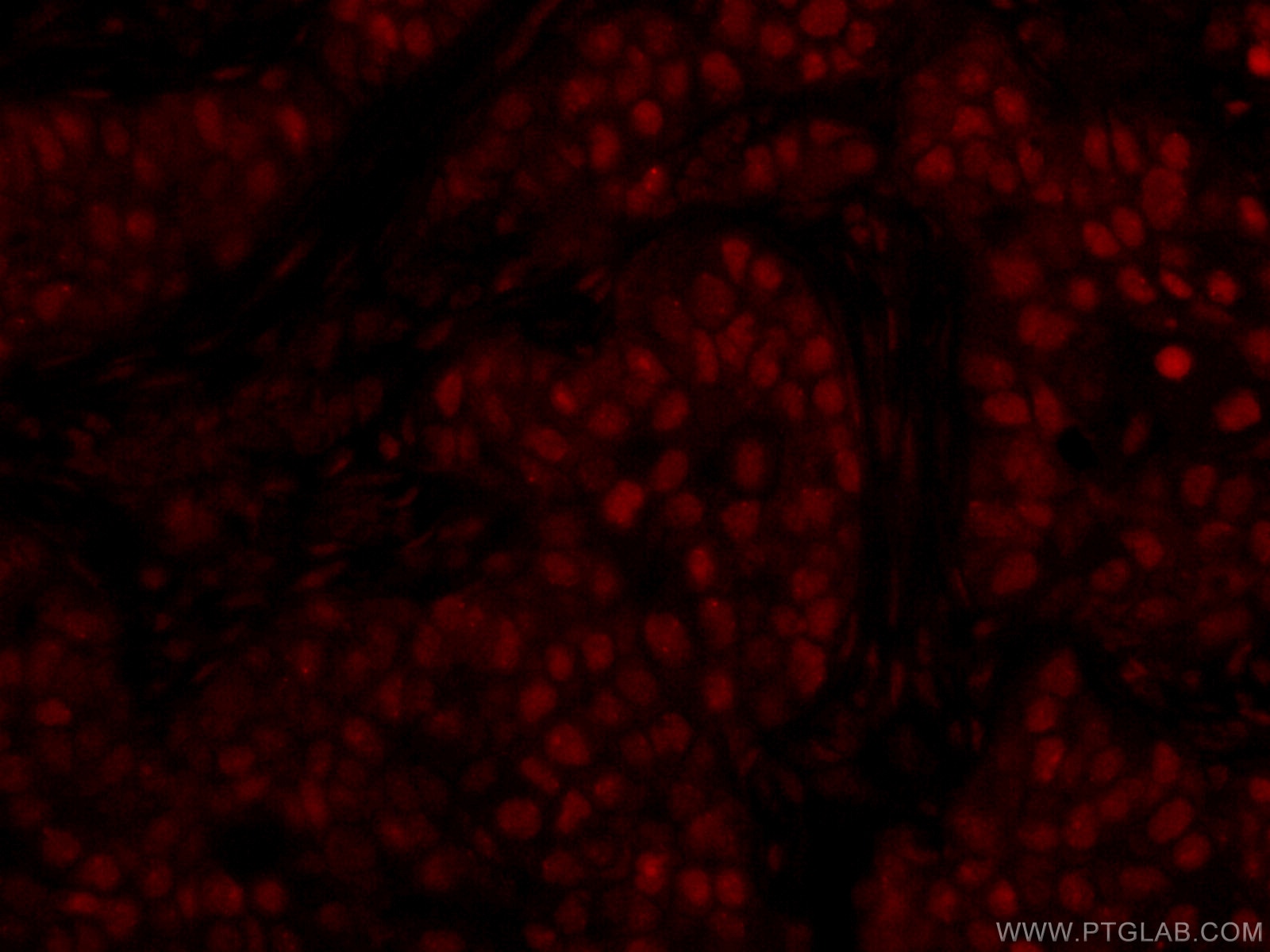 Immunofluorescence (IF) / fluorescent staining of human breast cancer tissue using CoraLite®594-conjugated GATA3 Monoclonal antibody (CL594-66400)