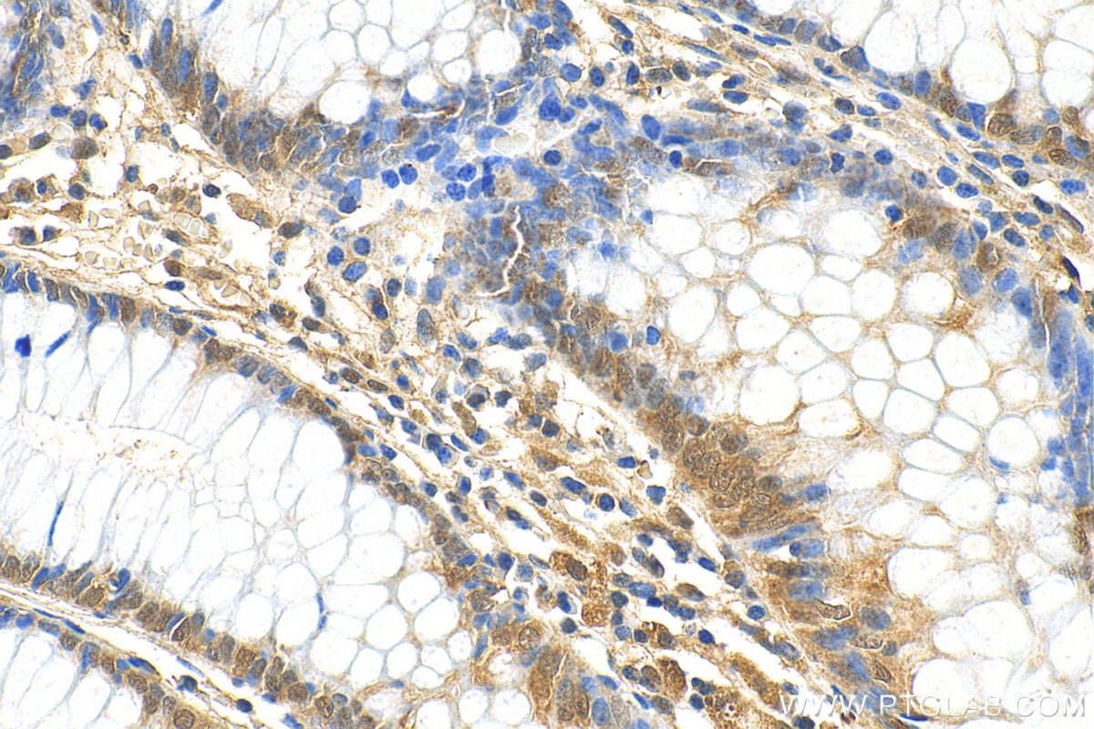 Immunohistochemistry (IHC) staining of human colon tissue using GATA5 Polyclonal antibody (55433-1-AP)