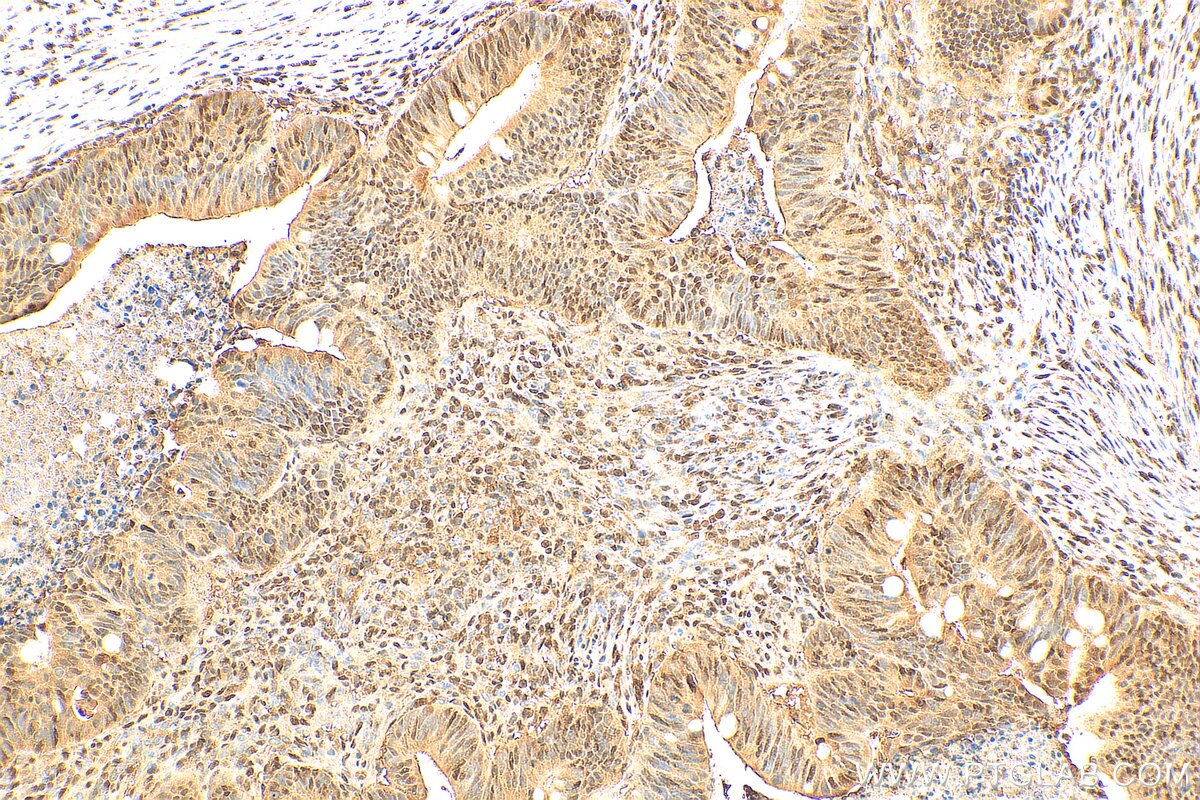 Immunohistochemistry (IHC) staining of human colon cancer tissue using GATA6 Polyclonal antibody (55435-1-AP)