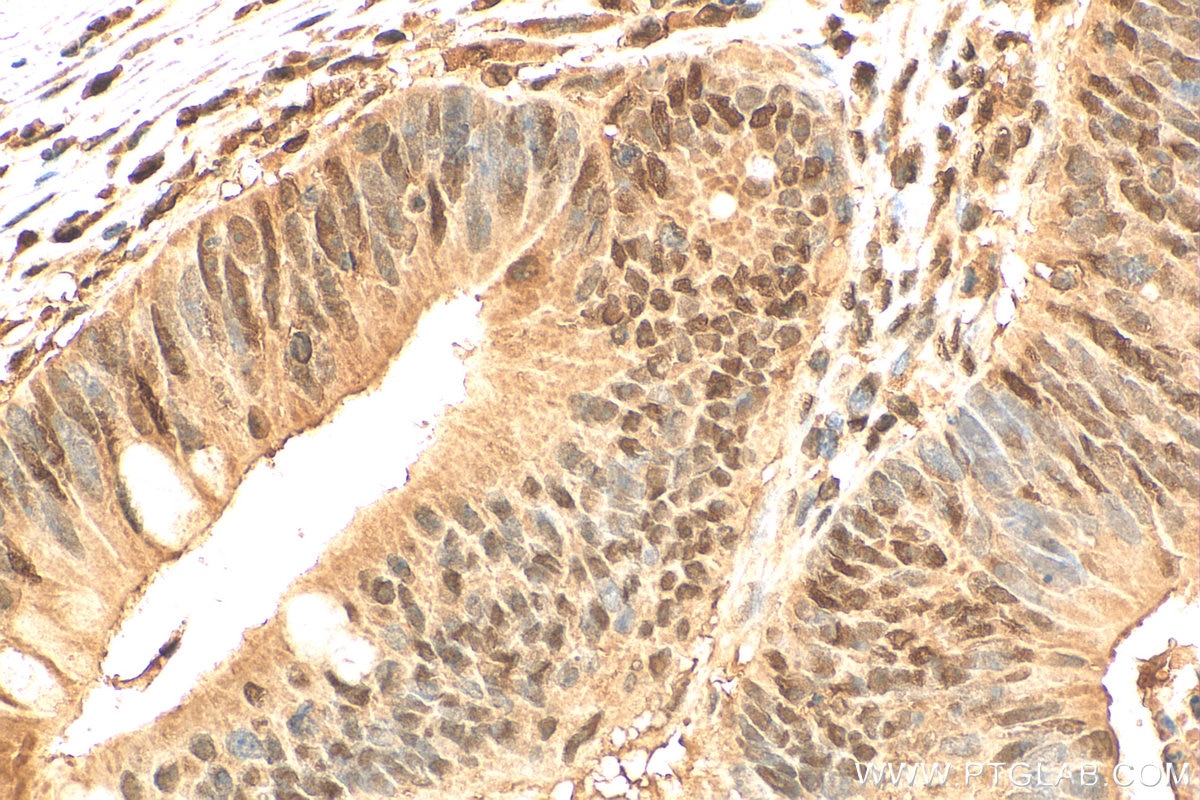 Immunohistochemistry (IHC) staining of human colon cancer tissue using GATA6 Polyclonal antibody (55435-1-AP)