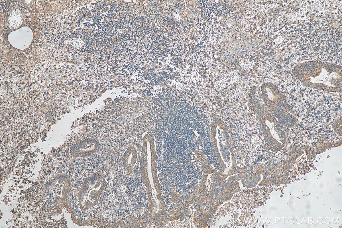Immunohistochemistry (IHC) staining of human appendicitis tissue using GATC Polyclonal antibody (23183-1-AP)