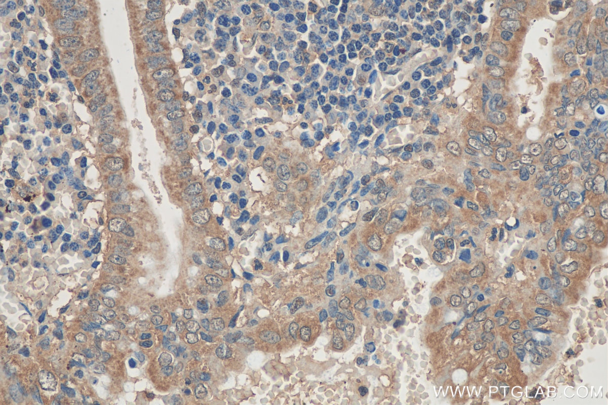 Immunohistochemistry (IHC) staining of human appendicitis tissue using GATC Polyclonal antibody (23183-1-AP)