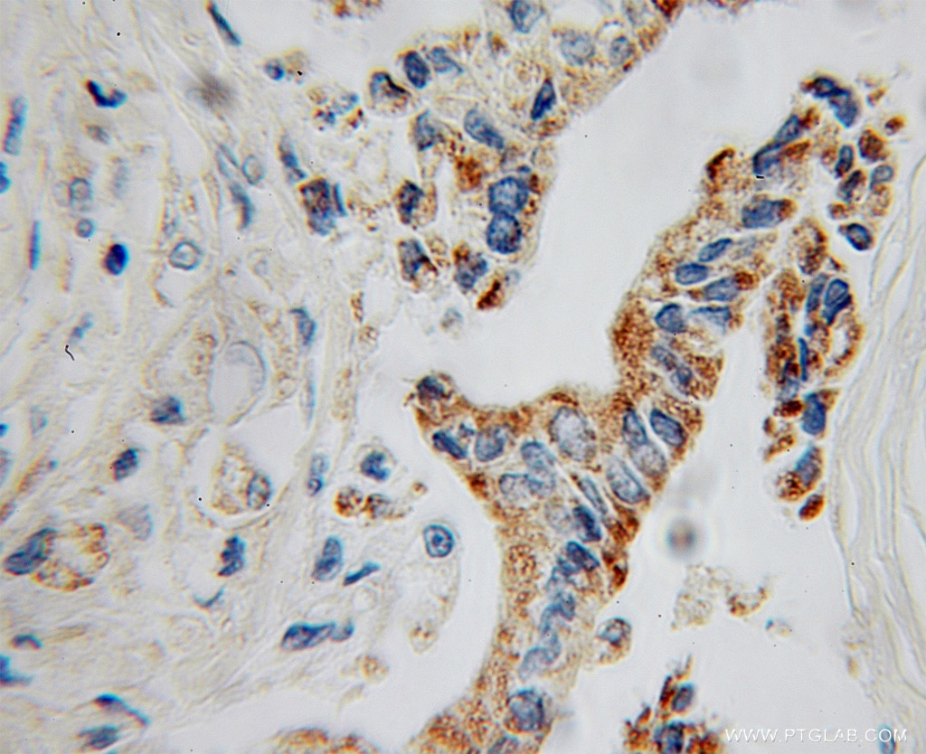 Immunohistochemistry (IHC) staining of human pancreas cancer tissue using GATM Polyclonal antibody (12801-1-AP)