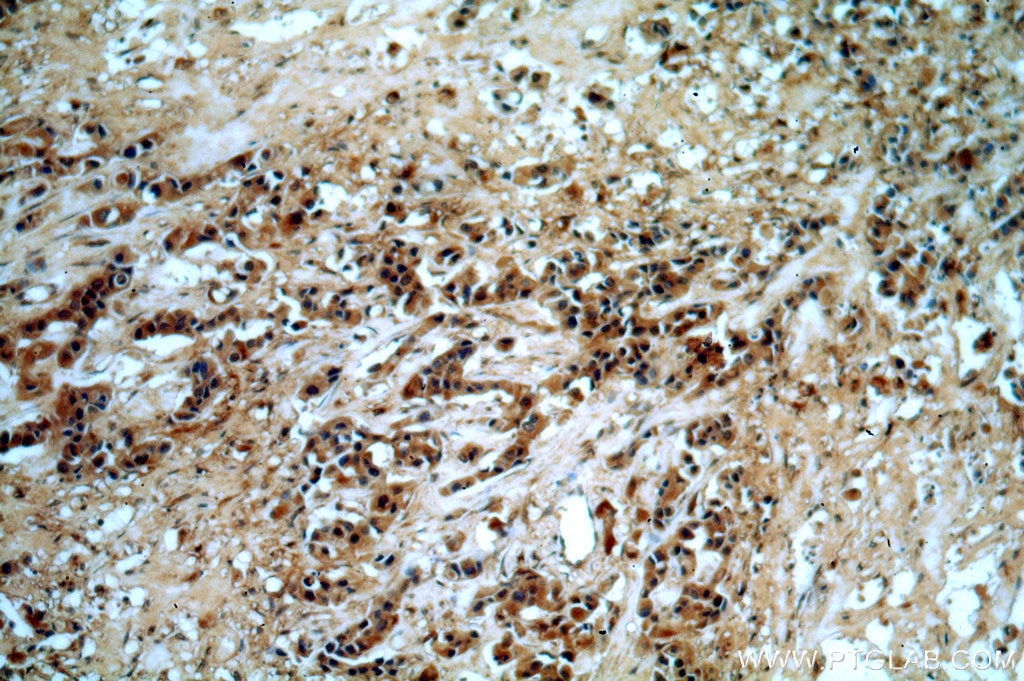 Immunohistochemistry (IHC) staining of human breast cancer tissue using GBA Polyclonal antibody (20622-1-AP)