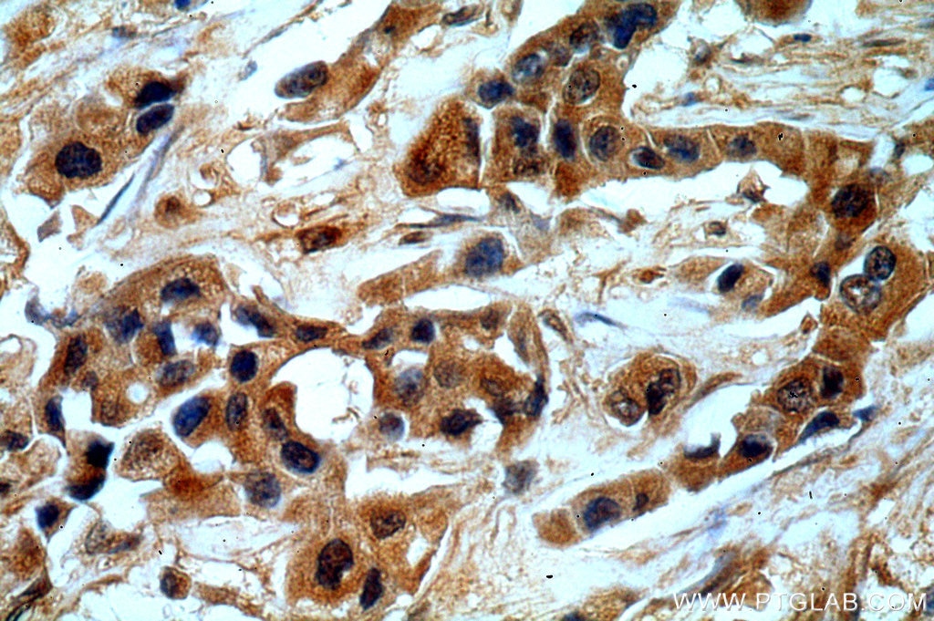 Immunohistochemistry (IHC) staining of human breast cancer tissue using GBA Polyclonal antibody (20622-1-AP)
