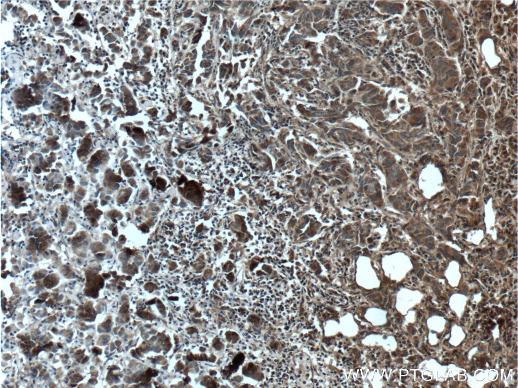 Immunohistochemistry (IHC) staining of human prostate cancer tissue using GBF1 Polyclonal antibody (25183-1-AP)