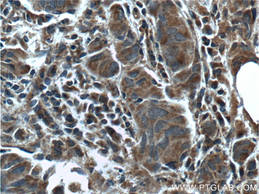 Immunohistochemistry (IHC) staining of human prostate cancer tissue using GBF1 Polyclonal antibody (25183-1-AP)