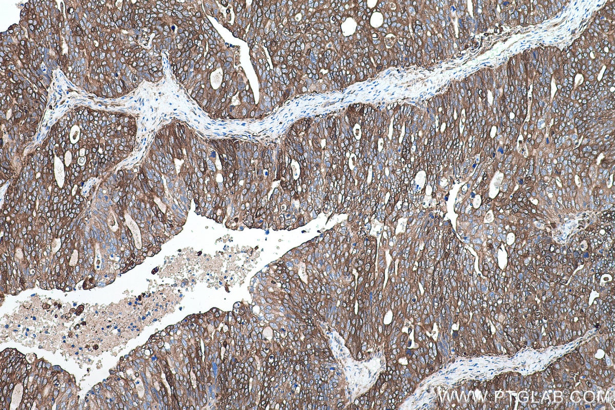 Immunohistochemistry (IHC) staining of human ovary tumor tissue using GBP1 Monoclonal antibody (67161-1-Ig)