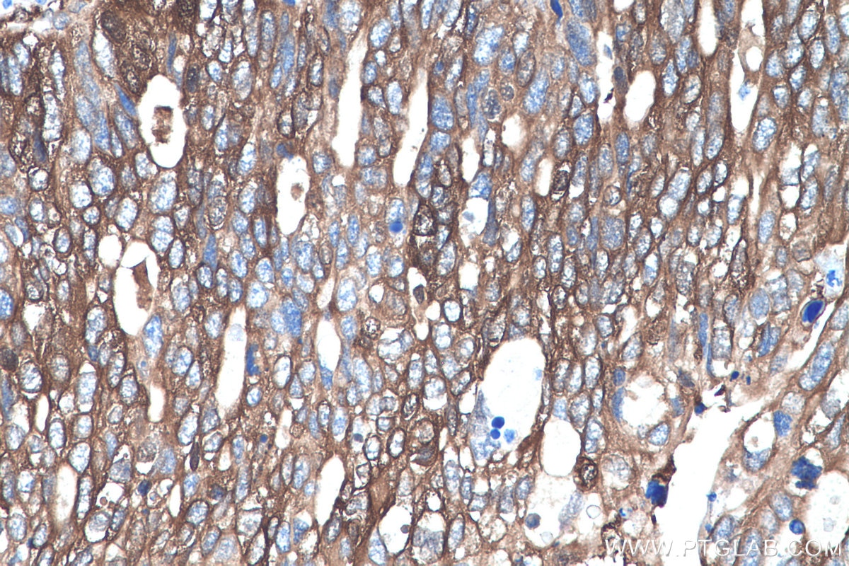Immunohistochemistry (IHC) staining of human ovary tumor tissue using GBP1 Monoclonal antibody (67161-1-Ig)