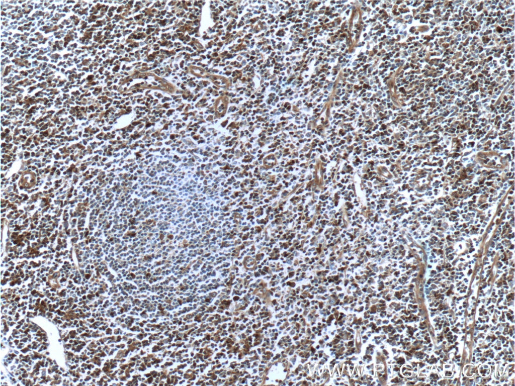 Immunohistochemistry (IHC) staining of human tonsillitis tissue using GBP2 Polyclonal antibody (11854-1-AP)