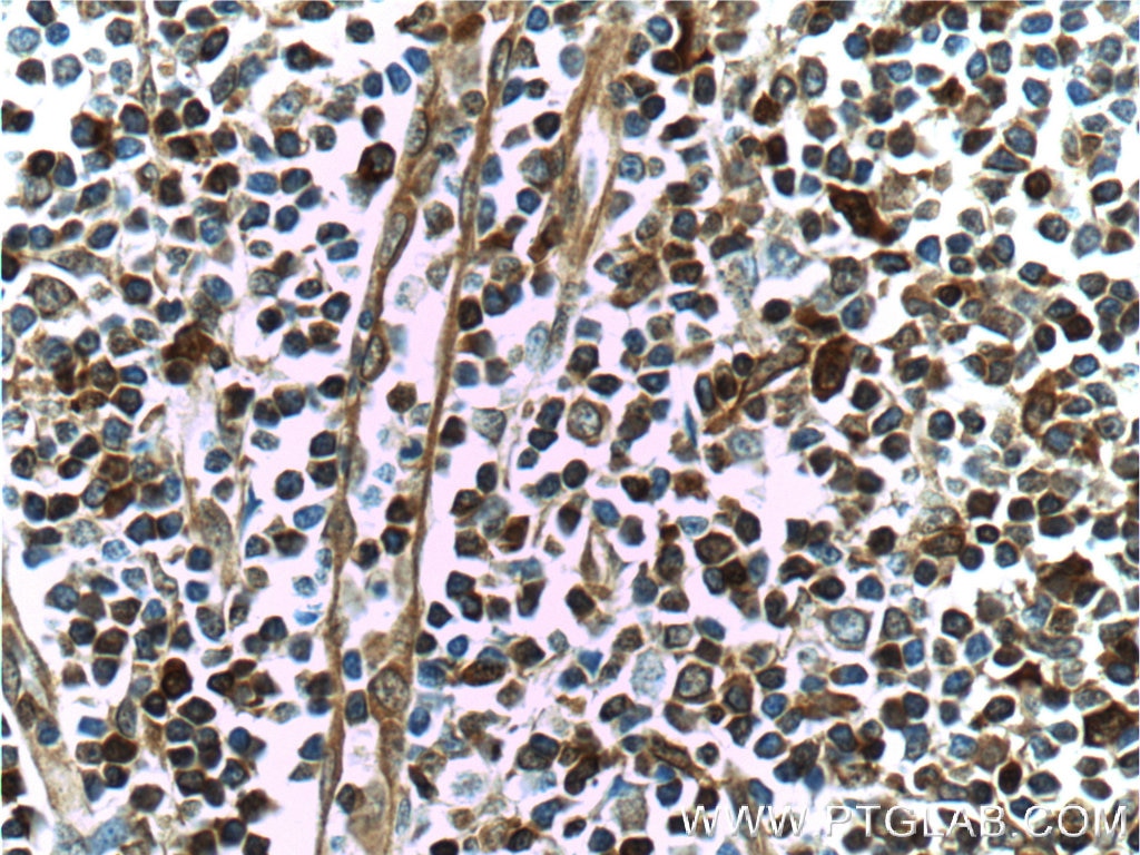 Immunohistochemistry (IHC) staining of human tonsillitis tissue using GBP2 Polyclonal antibody (11854-1-AP)