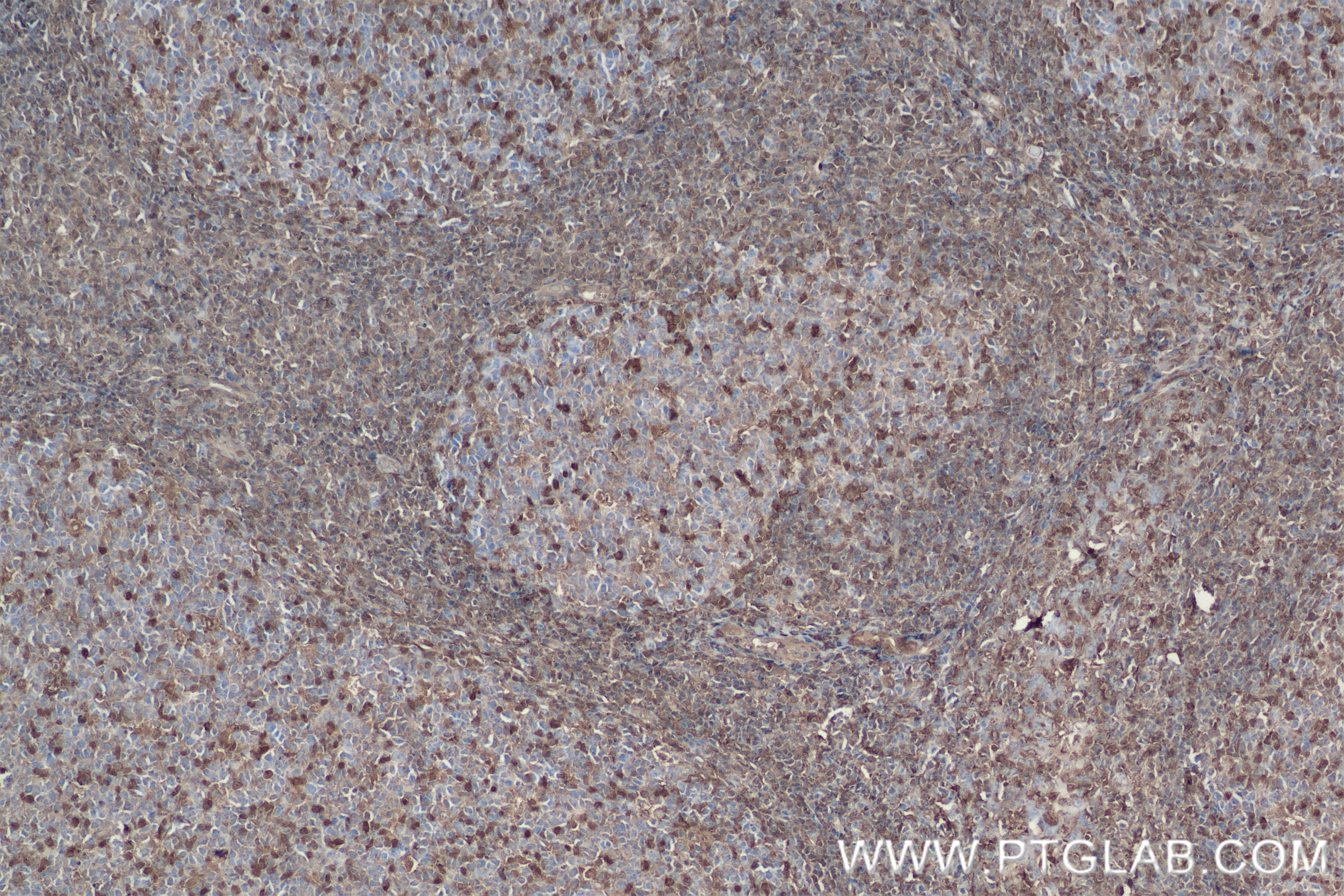 Immunohistochemistry (IHC) staining of human tonsillitis tissue using GBP2 Recombinant antibody (84264-6-RR)