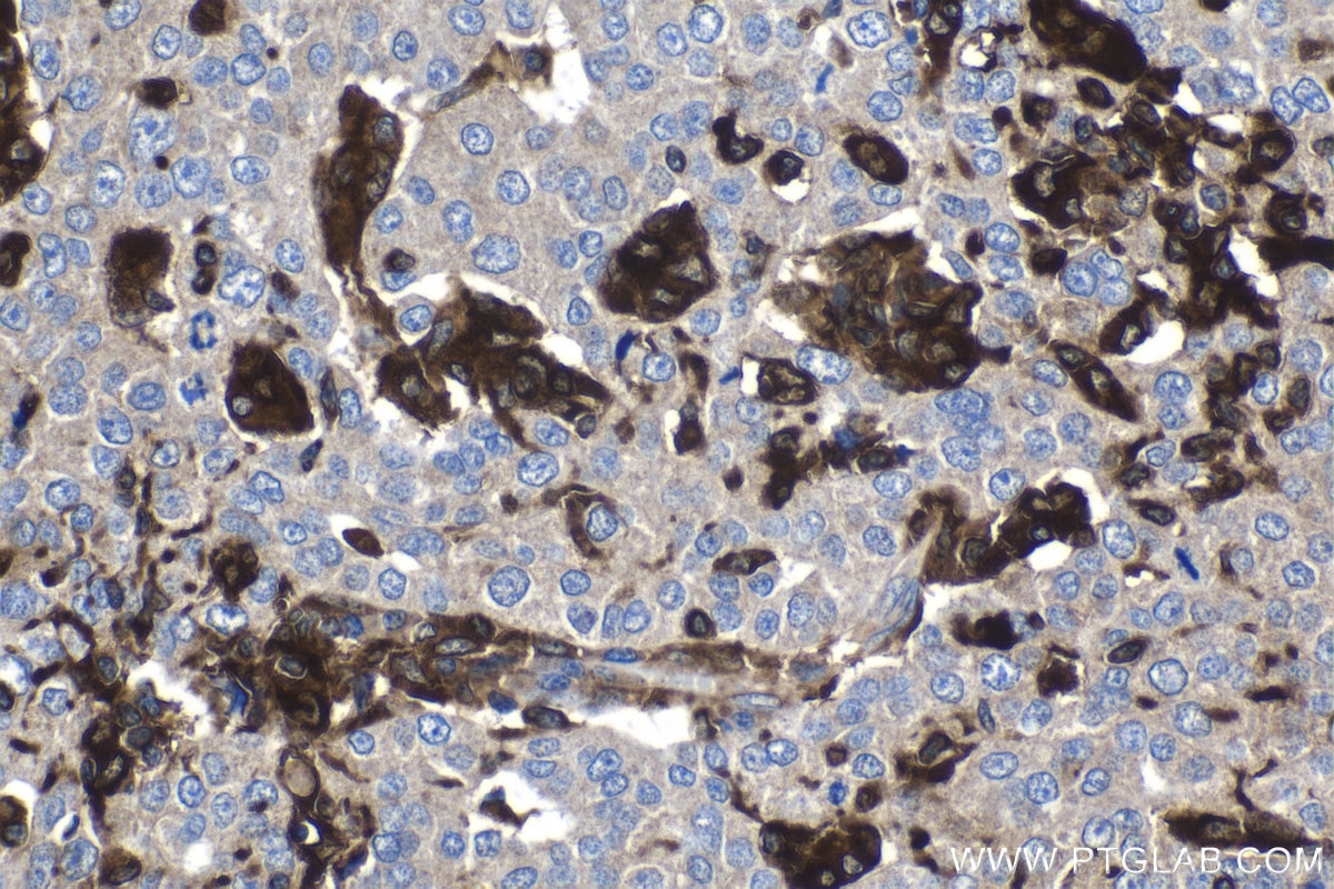 Immunohistochemistry (IHC) staining of human ovary tumor tissue using GBP5 Polyclonal antibody (13220-1-AP)