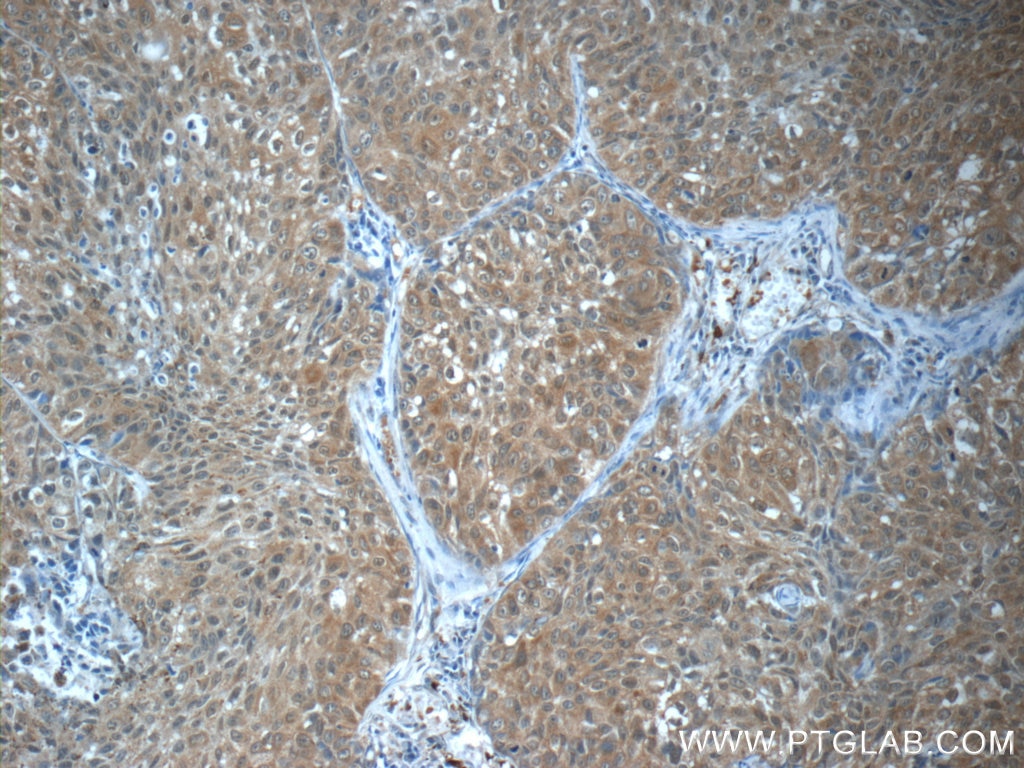 IHC staining of human lung cancer using 23001-1-AP