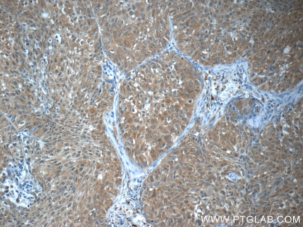 Immunohistochemistry (IHC) staining of human lung cancer tissue using GBP6 Polyclonal antibody (23001-1-AP)