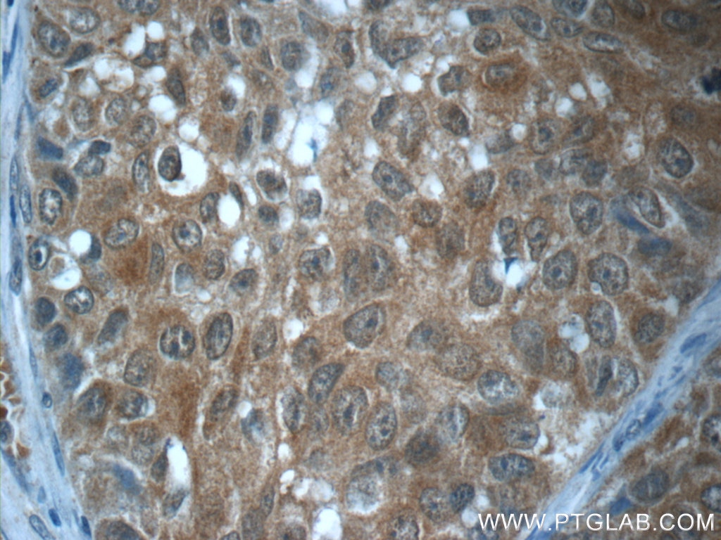 Immunohistochemistry (IHC) staining of human lung cancer tissue using GBP6 Polyclonal antibody (23001-1-AP)