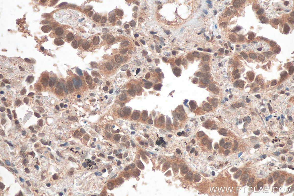 Immunohistochemistry (IHC) staining of human lung cancer tissue using GBP6 Polyclonal antibody (23001-1-AP)
