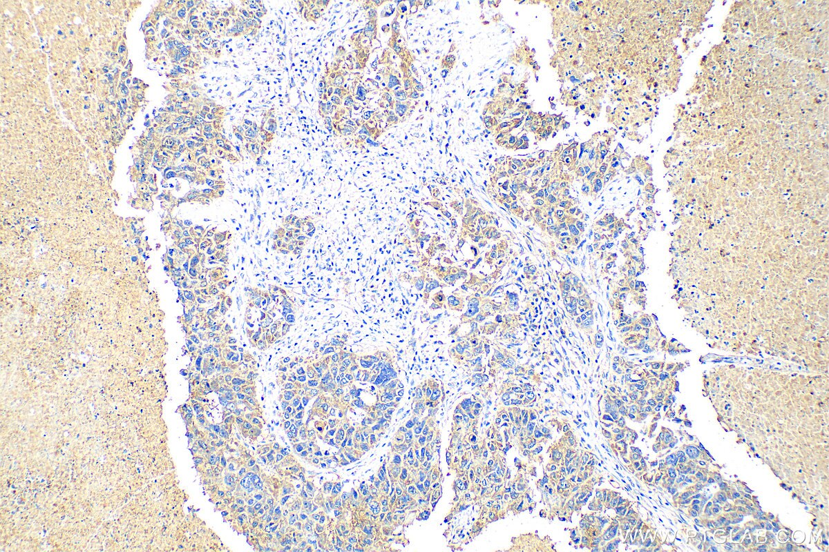 Immunohistochemistry (IHC) staining of human ovary cancer tissue using GBX1 Polyclonal antibody (55035-1-AP)