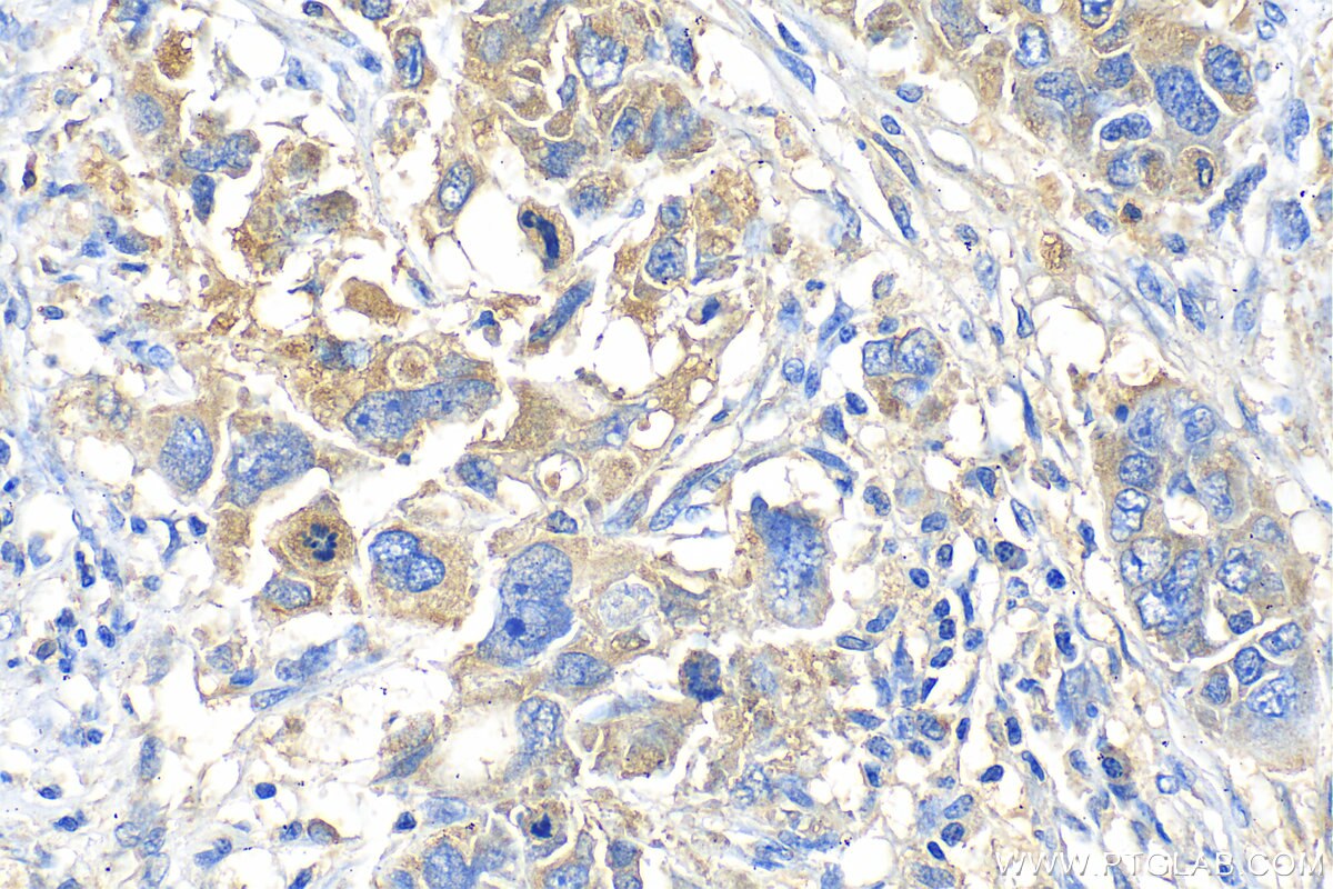 Immunohistochemistry (IHC) staining of human ovary cancer tissue using GBX1 Polyclonal antibody (55035-1-AP)
